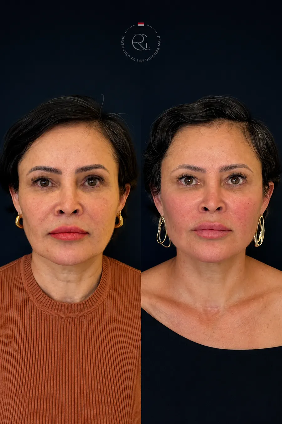 Antes e depois do Protocolo RG® em Curitiba, caso 1, publicado com autorização da paciente