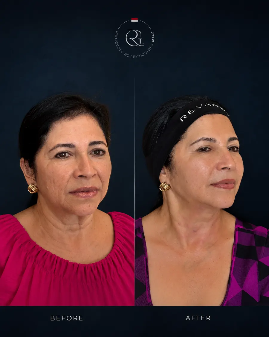 Antes e depois do Protocolo RG® em Curitiba, caso 2, publicado com autorização da paciente