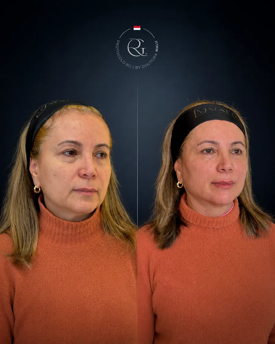 Antes e depois do Protocolo RG® em Curitiba, caso 3, publicado com autorização da paciente