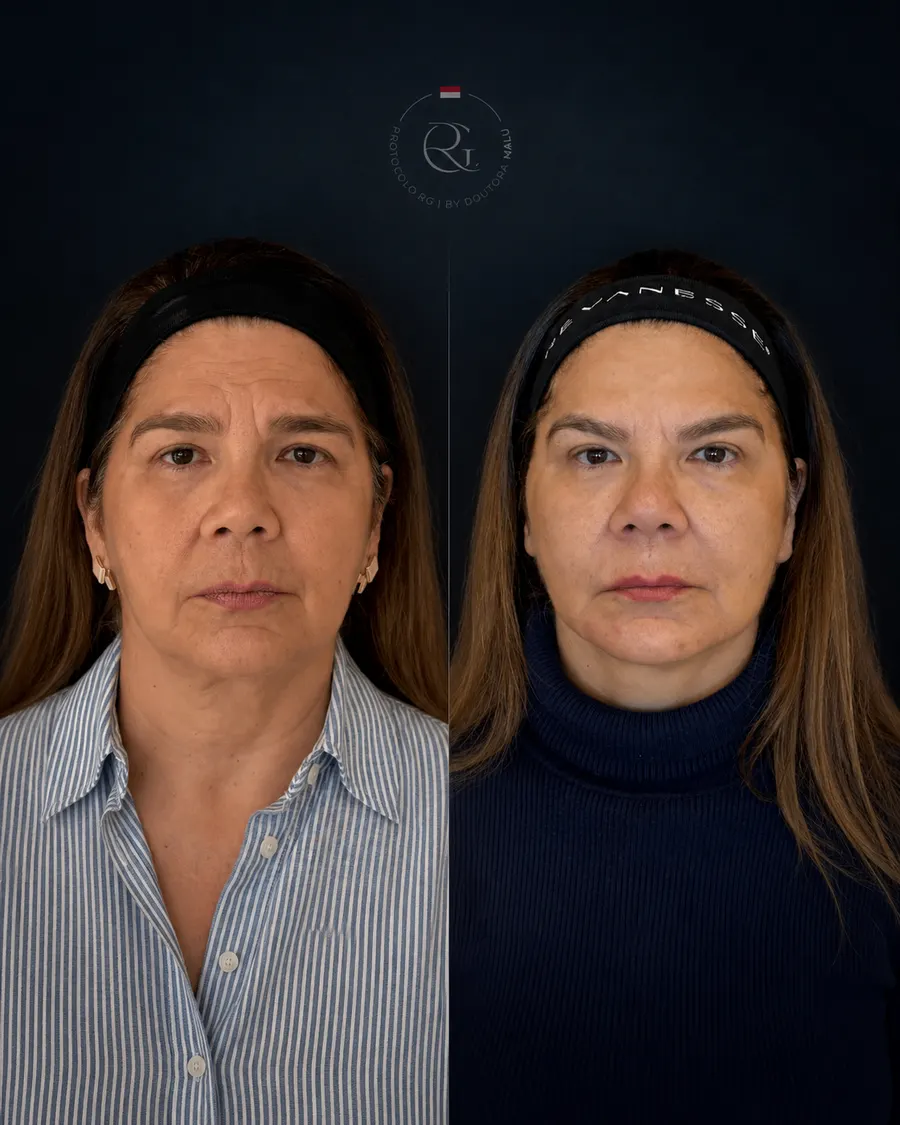 Antes e depois do Protocolo RG® em Curitiba, caso 4, publicado com autorização da paciente