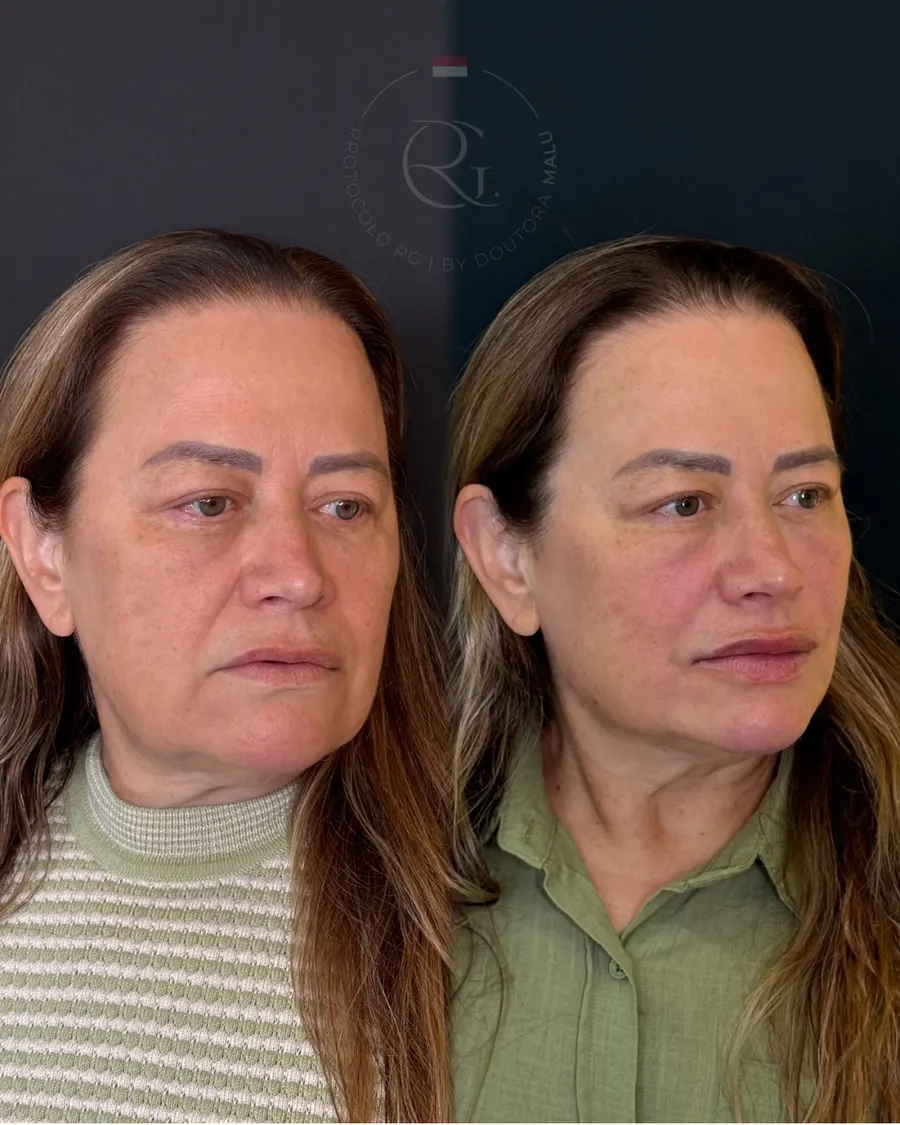 Antes e depois do Protocolo RG® em Curitiba, caso 5, publicado com autorização da paciente
