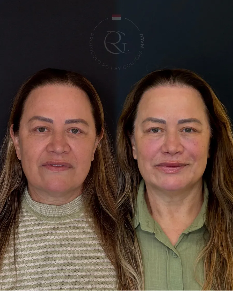 Antes e depois do Protocolo RG® em Curitiba, caso 6, publicado com autorização da paciente