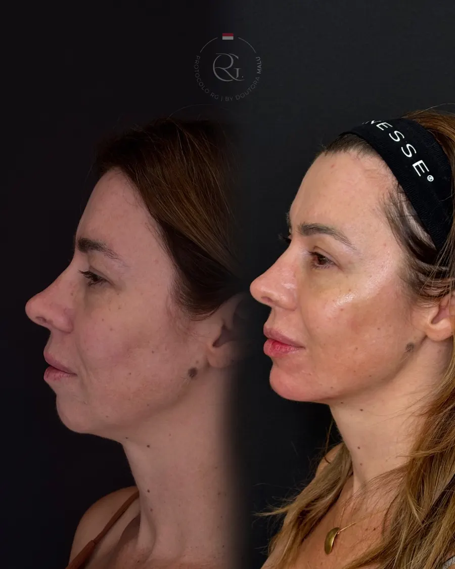 Antes e depois do Protocolo RG® em Curitiba, caso 7, publicado com autorização da paciente
