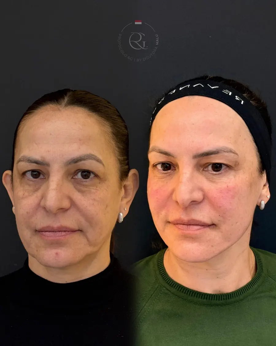 Antes e depois do Protocolo RG® em Curitiba, caso 8, publicado com autorização da paciente