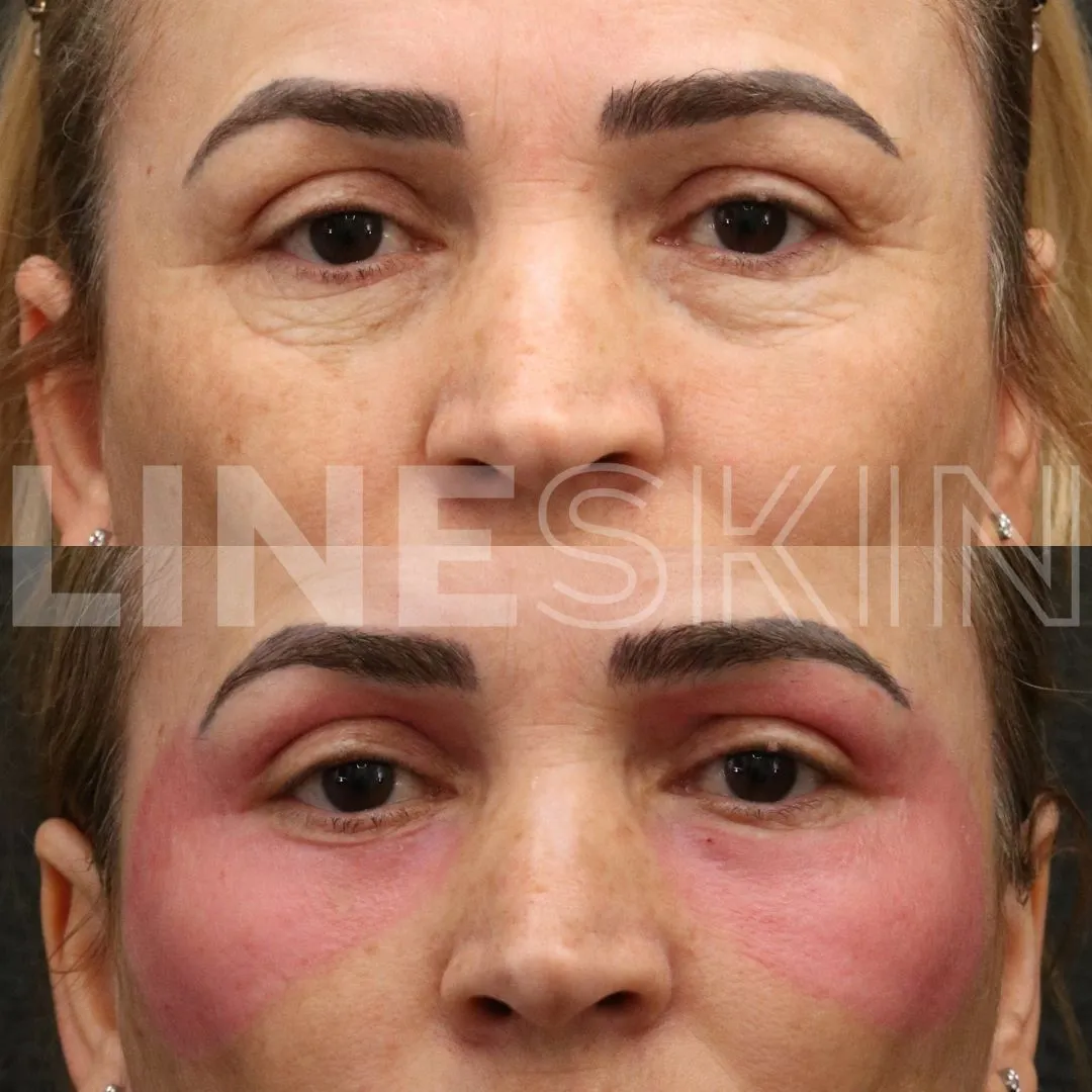 Aplicação do Peeling Line Skin (ATA) pelo método Line Skin em Curitiba