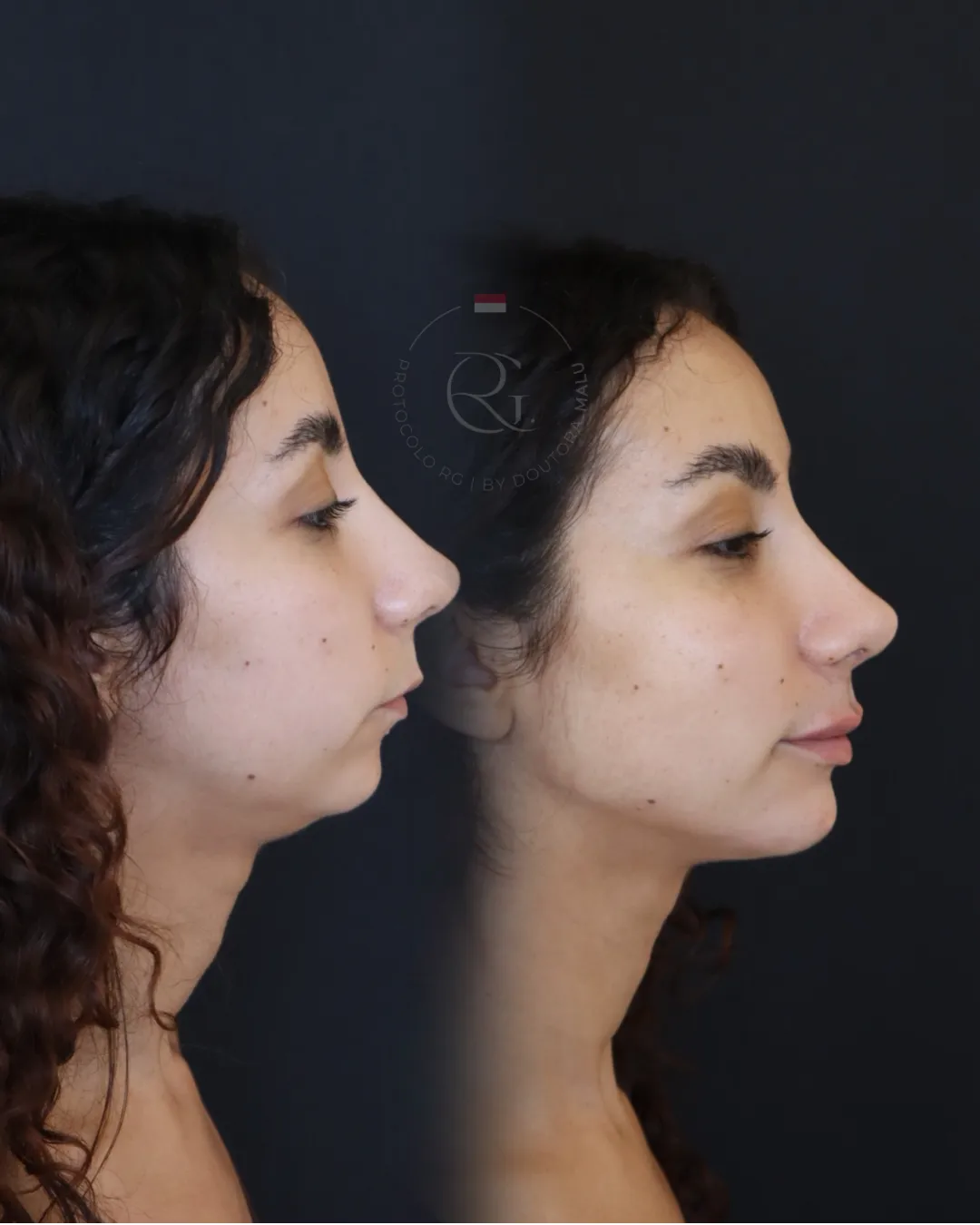 Análise de perfil para perfiloplastia não cirúrgica em Curitiba