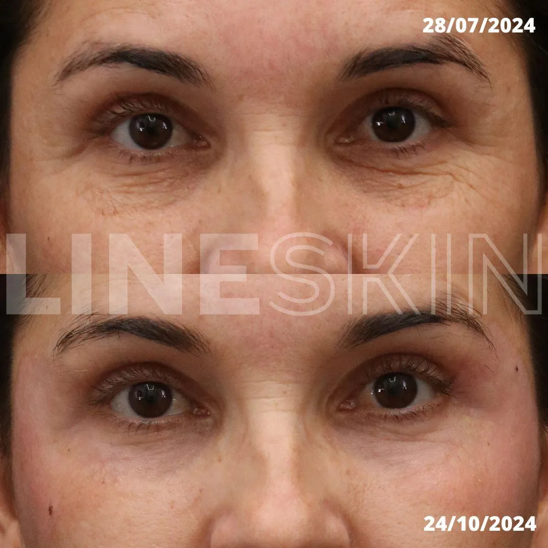 Antes e depois de preenchimento de olheiras em Curitiba com o Protocolo RG®