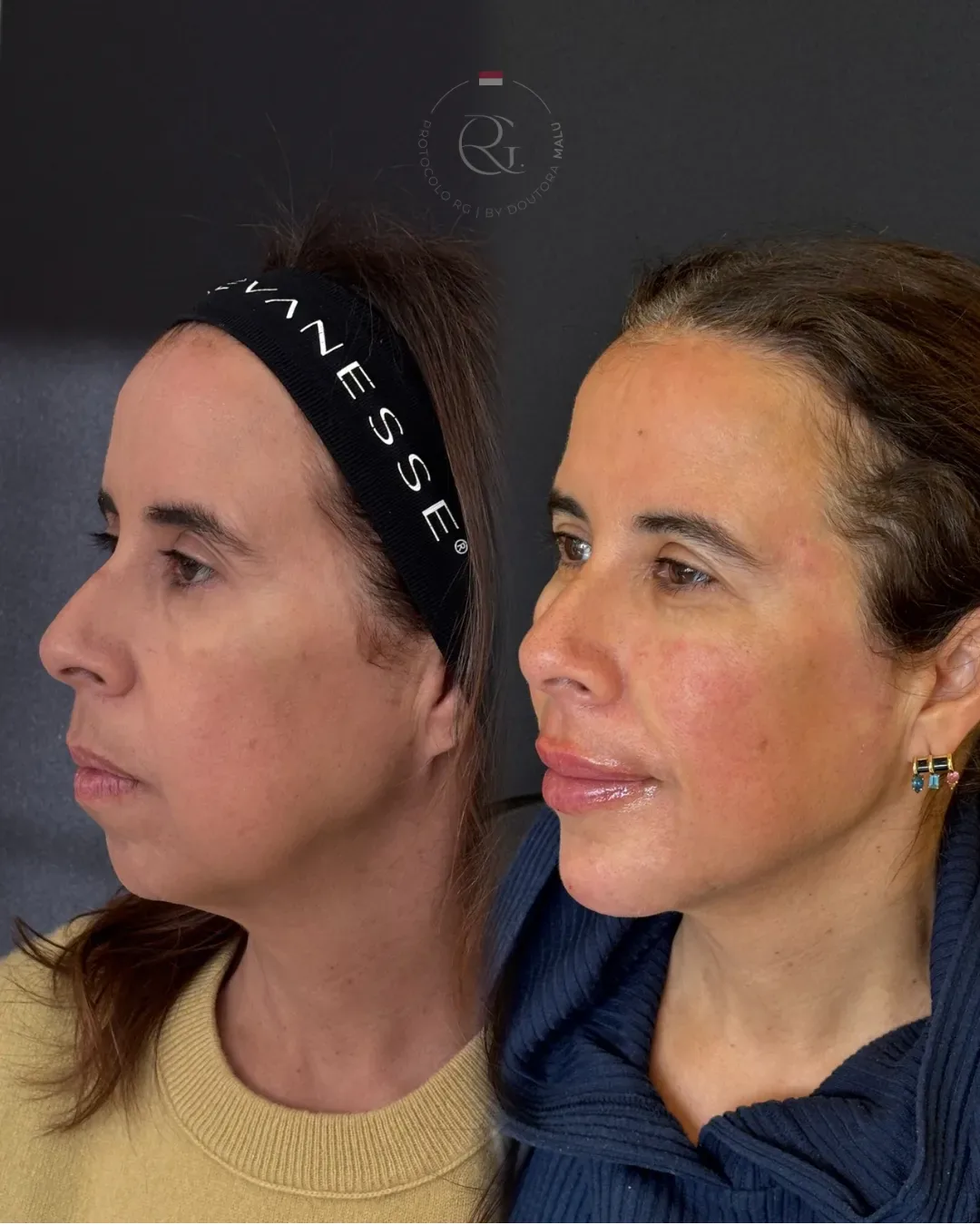 Antes e depois de tratamento para bigode chinês em Curitiba
