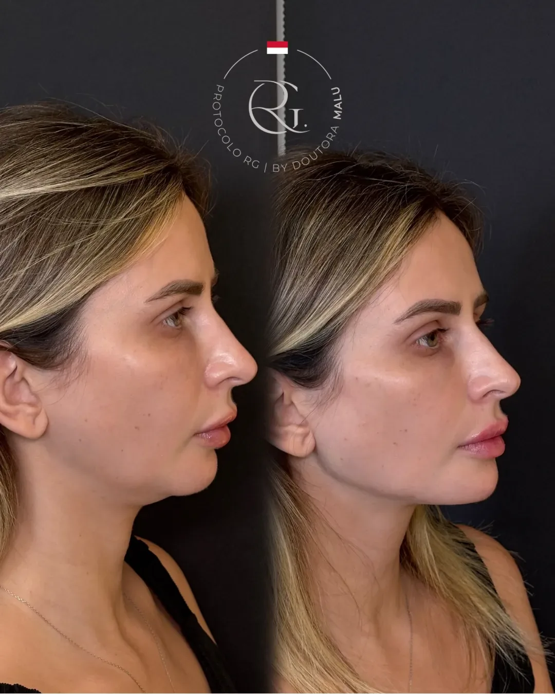 Antes e depois de tratamento para papada e contorno facial em Curitiba